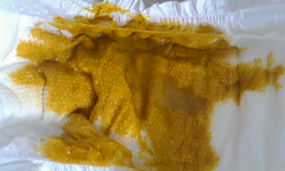 宝宝拉的大便问题,有图慎入 - 幼儿护理 - 育儿论坛