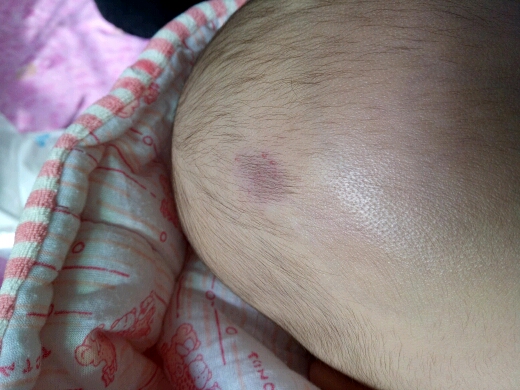 各位妈妈,我宝宝头上的是血管瘤吗?
