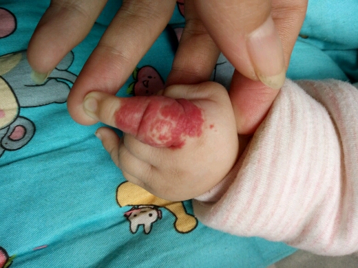 1楼 主题:孩子有血管瘤手上,有没有同样情况的?求救