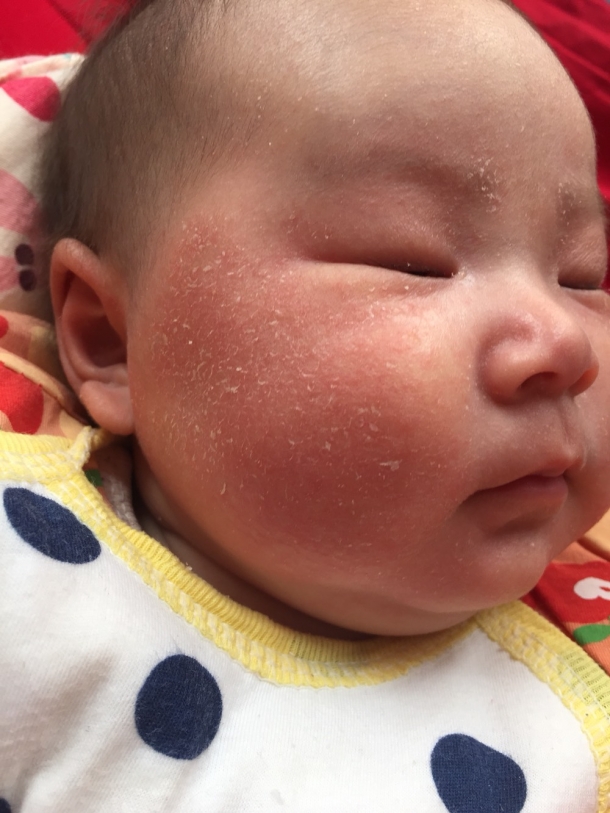 宝妈们帮我看下我家宝宝脸上怎么起皮是怎么回