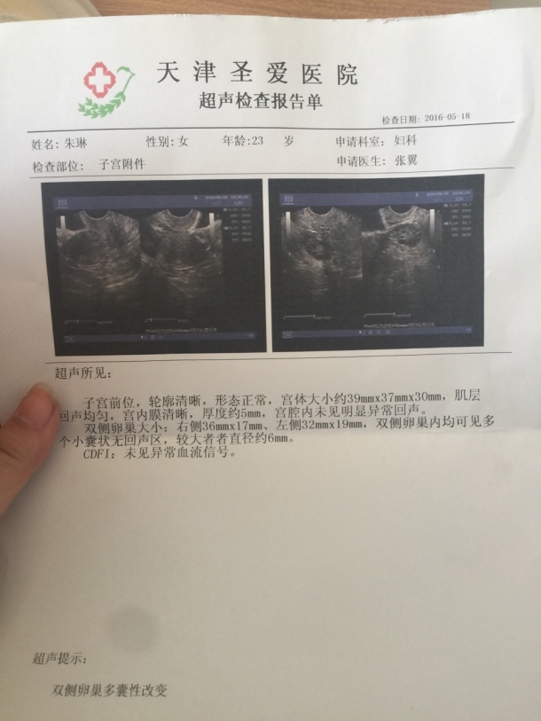 大家帮我看看这是多囊卵巢综合症吗?