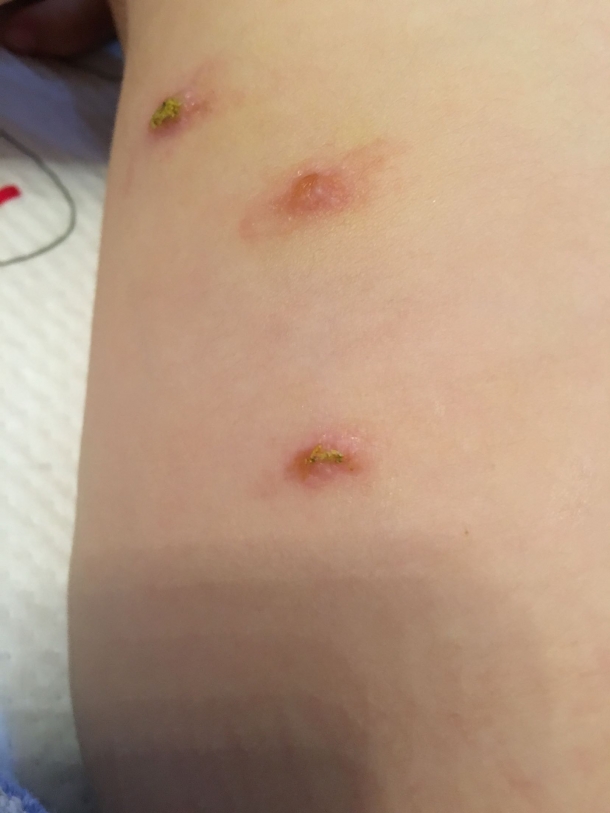 宝宝身上起红疙瘩又变成水泡特别痒 - 幼儿护理