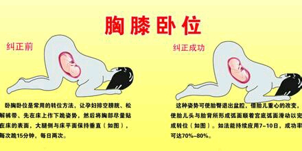 臀位怎么办?