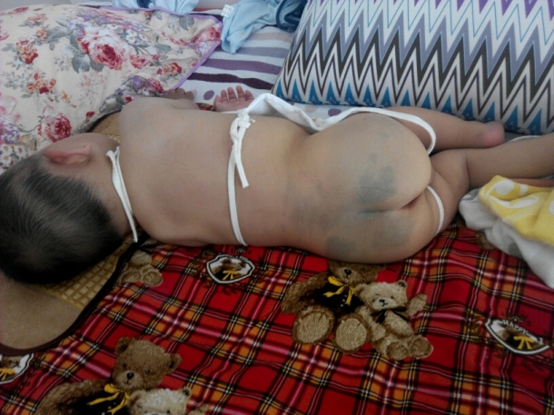 关于宝宝屁股上的青色胎记的传说 - 幼儿护理论