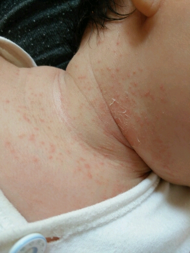          宝宝湿疹,只有脖子有