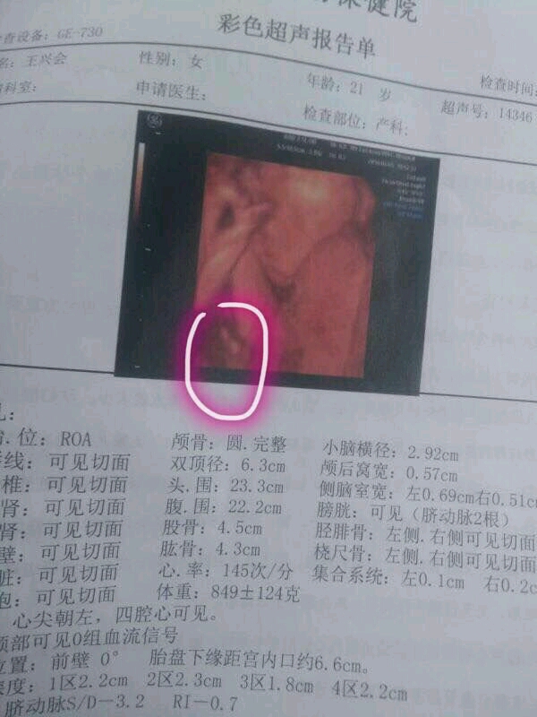 大家帮我看看这是不是男孩子的小鸡鸡