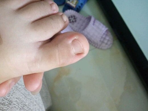 两岁宝宝脚趾甲长成这样!