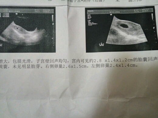 怀孕41,天没有胎心胎芽正常么 带图 - 孕期话题
