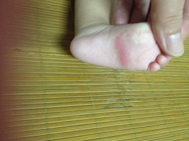宝宝左脚脚底红