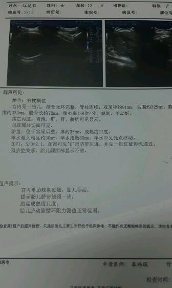 胎位是右枕横位到底正不正?
