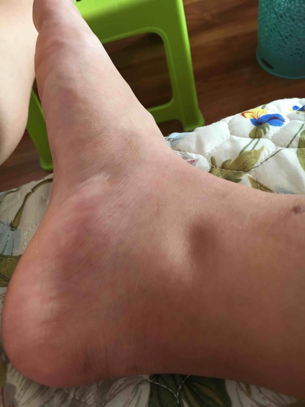 脚脖子肿了 - 孕期话题论坛