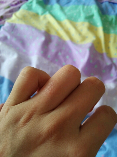 手上起红疙瘩,特别痒。是什么呢? - 孕期话题论