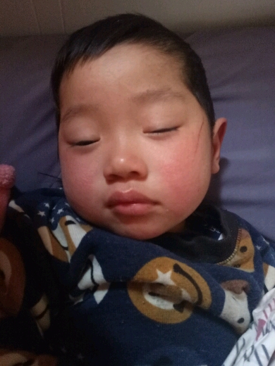 儿子脸很红,感觉像是角质层很薄的样子,怎么办