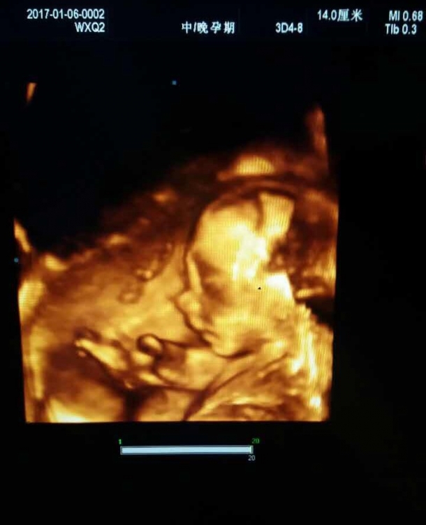 b超显示宝宝脸朝外 是男孩准 7.肚脐以上妊娠线细.