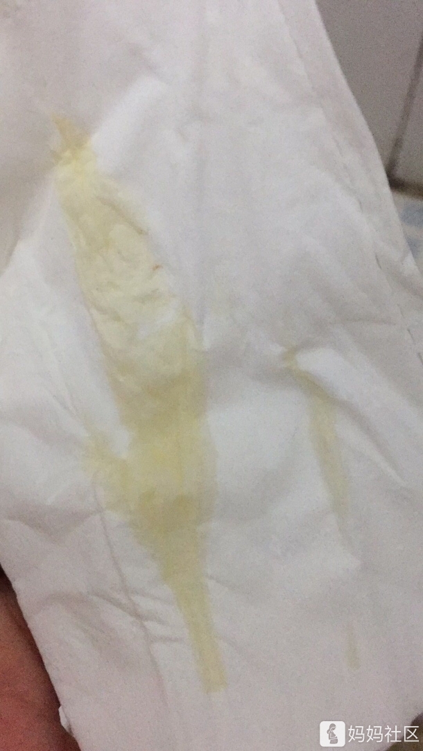 今天早上忽然就有很多这种分泌物,怎么回事?很担心,需要去医院吗?