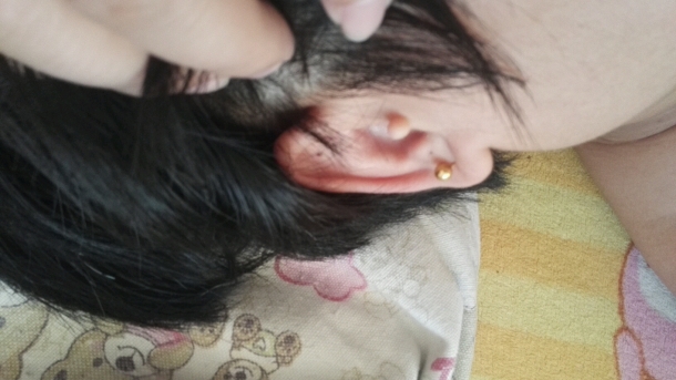 我女儿右耳朵长多一坨肉，怎么办