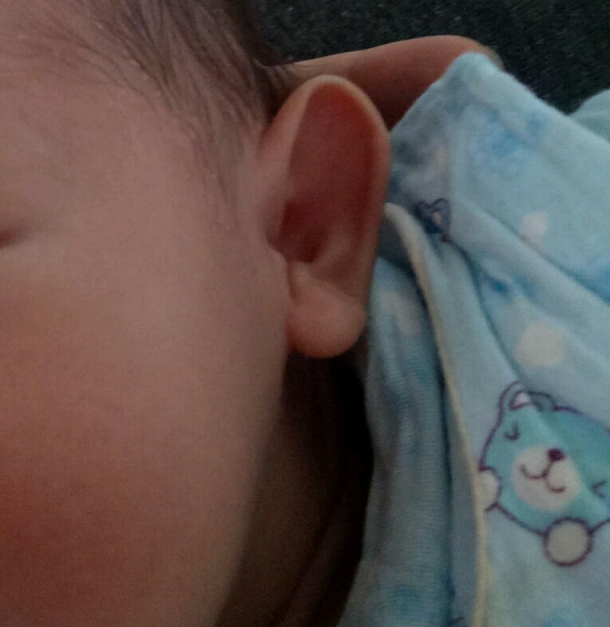 宝宝的两个耳朵不一样 - 幼儿护理