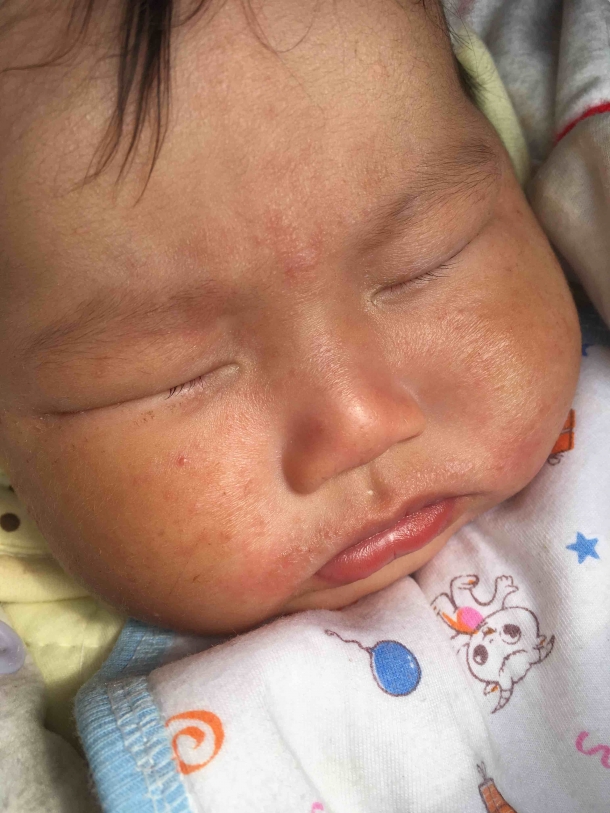 三个月的宝宝脸上真菌感染了宝妈们有没有好办