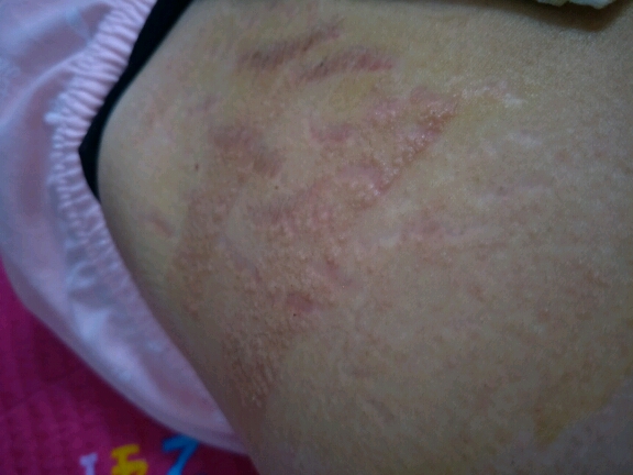 剖腹产后胶布过敏 - 幼儿护理论坛