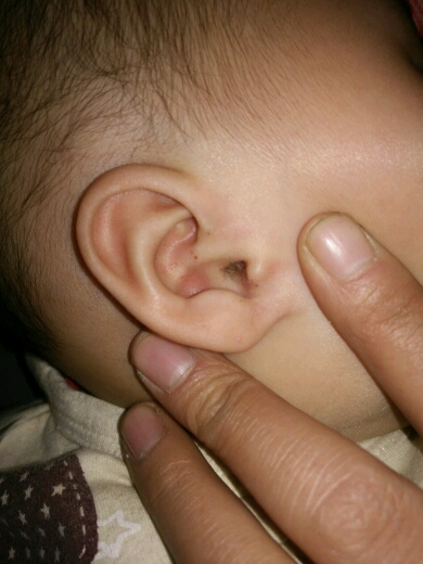 宝贝5个月了。耳朵里像是流脓了。怎么回事。