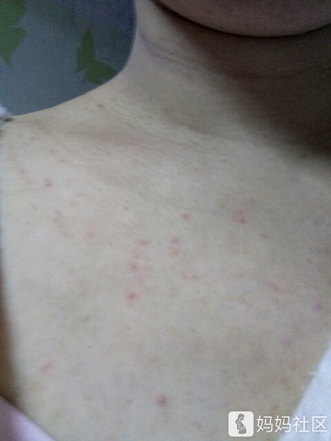 总胆汁酸高怎么办 有没有情况一样的