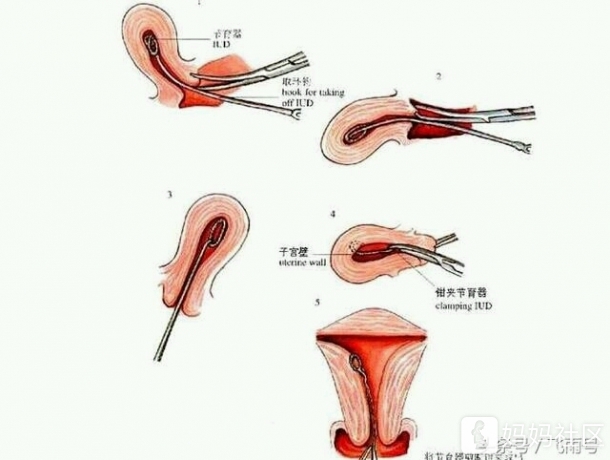 上环真的好吗?这些危害对身体也太了
