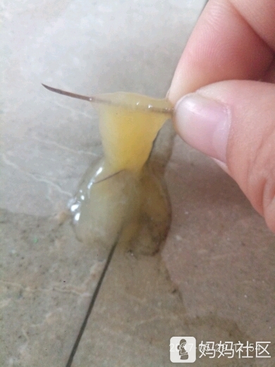 宝宝不拉肚子,拉出像果冻一样的东西,有图慎入