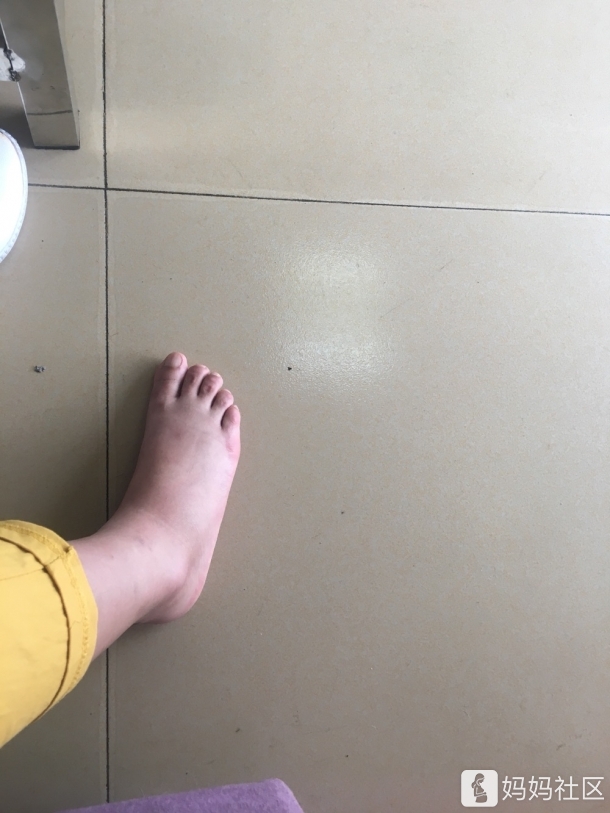 今天起床,发现脚肿成了猪蹄,怎么那么早就肿了?