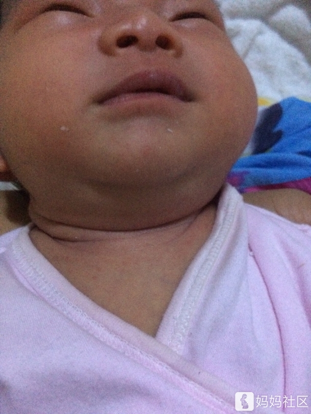 宝宝脖子肉多,起痱子了怎么办? - 幼儿护理