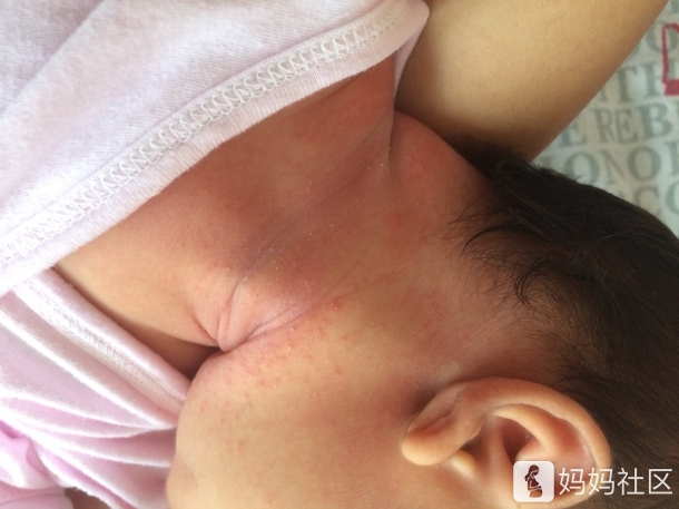 宝宝脖子肉多,起痱子了怎么办? - 幼儿护理