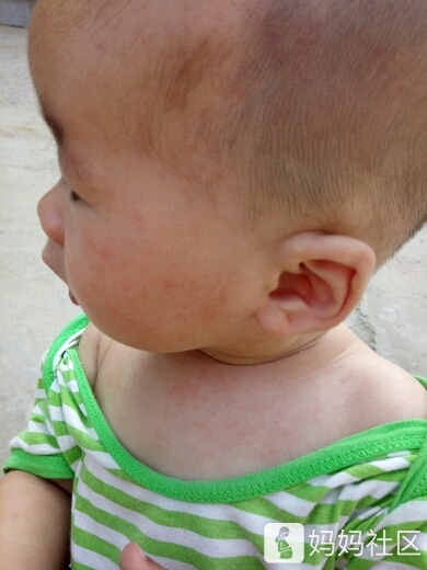 宝宝出过幼儿急疹的宝妈看过来，谢谢！