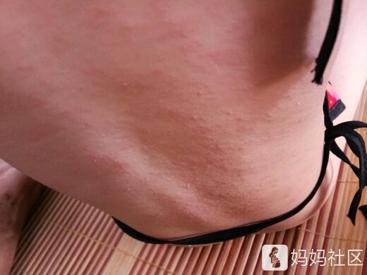 热痱还是湿疹?