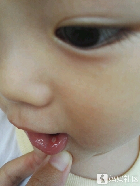 宝宝长溃疡嘴巴里面怎么办?