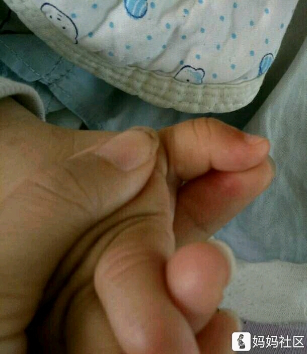 我家宝宝大拇指申不直,看图,宝妈们都进来交流一下