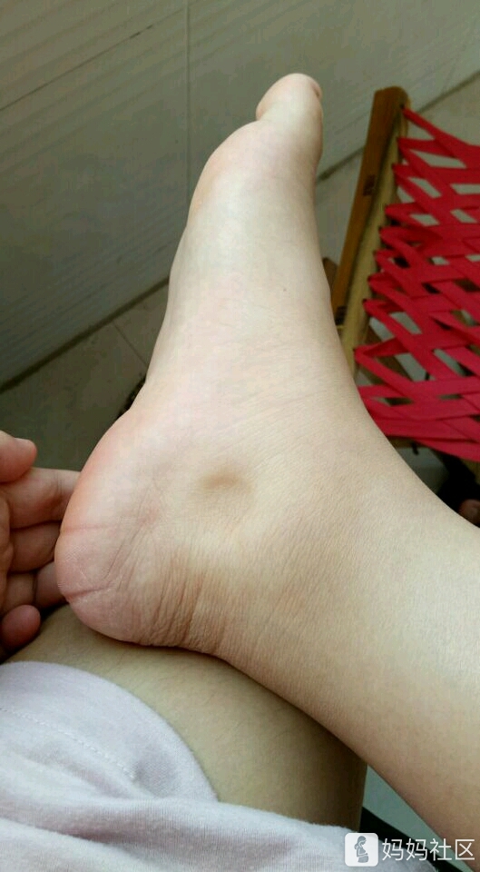 脚肿腿肿 身体臃肿