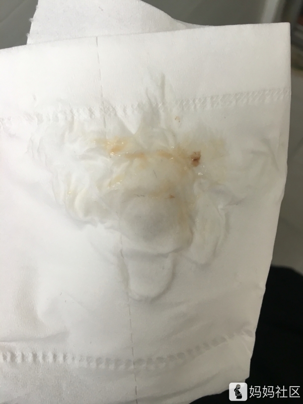 这个月11号来姨妈,很少三天就干净了,这几天白带异常如下,需要去看