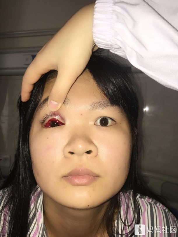 想了好久终于决定去做了斜视手术