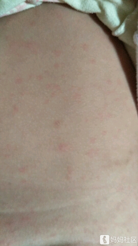 有没有宝妈知道发烧后出疹子是怎么回事?