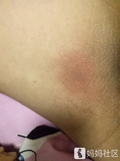 忽略我的大腿根部发黑[哭]