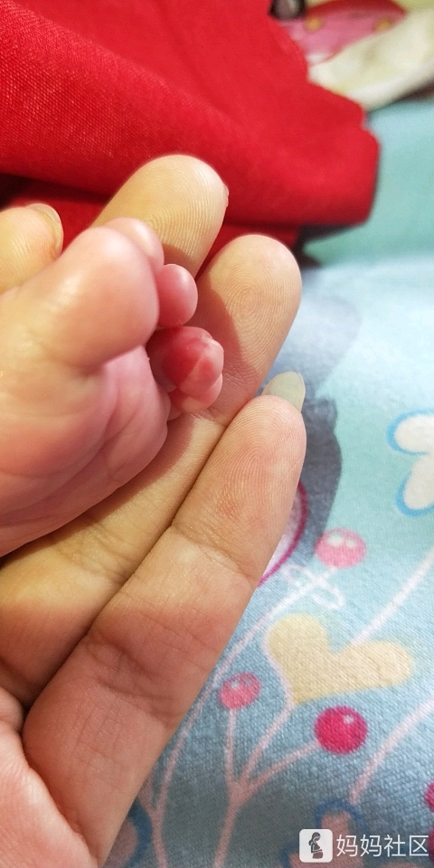 新生儿脚趾红谁帮我看看