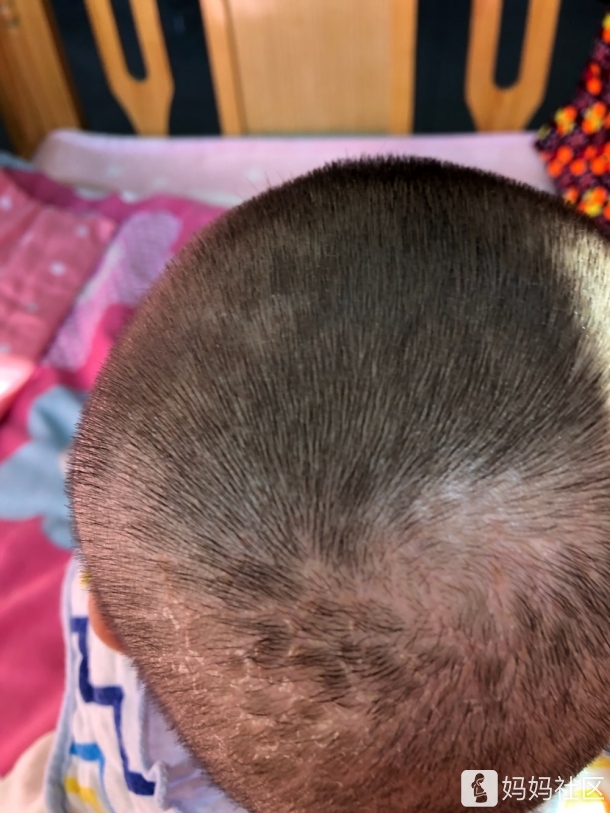 5个月了,我一直被孩子的湿疹困扰着,出生后就是干性湿疹
