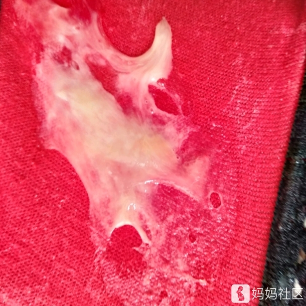 白带异常你们都是怎么处理的