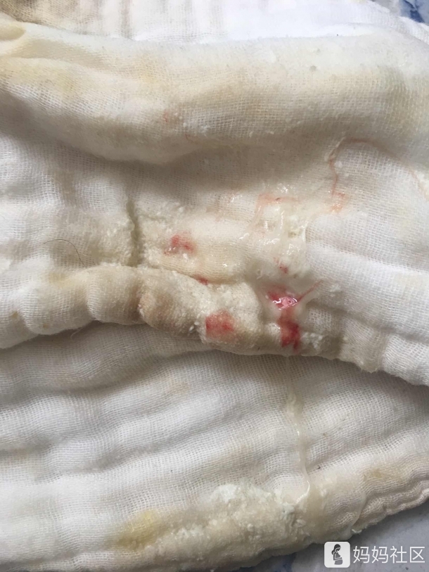 宝宝肺炎咳嗽吐血