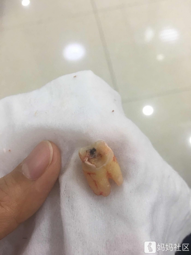 哺乳期拔智齿了(有图胆小慎点)