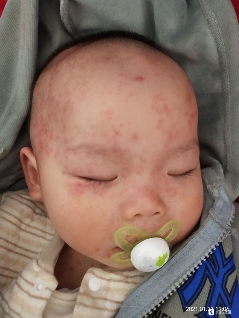 有点吓人，懂的宝妈来，这是幼儿急疹吗？