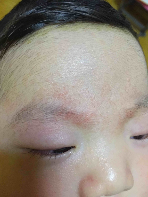 宝宝眉毛中间最近长了好多红疹子是怎么回事?也不知道他痒不痒
