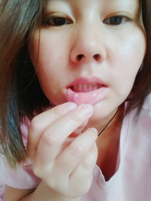 总是口腔溃疡容易上火咋整啊