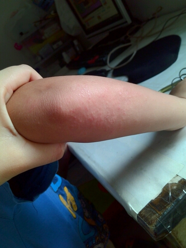 我儿子身上长了好多痱子手背也是