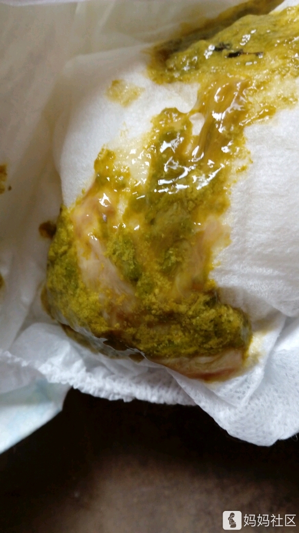 二宝是好十几天就又开始拉屎,都这样闹了三回了,每次化验大便是肠炎